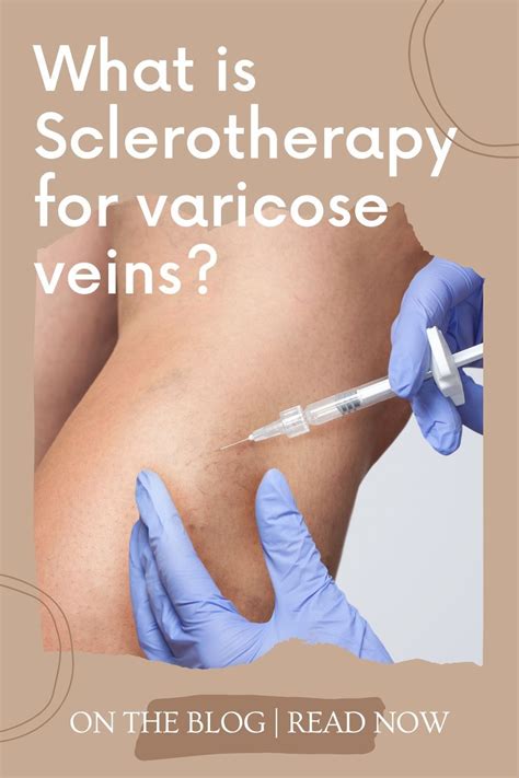 What Is Sclerotherapy For Varicose Veins Artofit