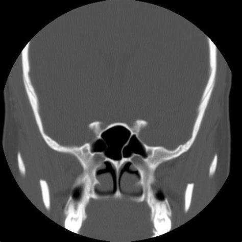 A Bilateral Type 0 On Optic Nerves Do Not Border Sphenoid Sinus