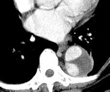 Learningradiology Acute Abdominal Pain And Ct