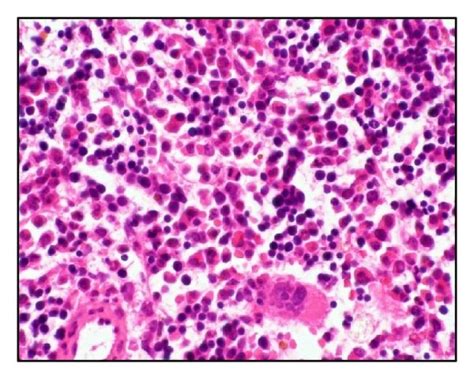 Case 2 Histology Of Bone Marrow HE Stain A Before HCT The Bone