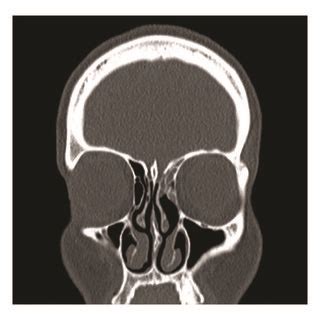 Preoperative Coronal CT Scan Demonstrating Evidence Of Soft Tissue