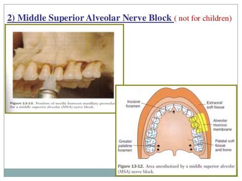 Local Anesthesia For Pediatric Dentistry