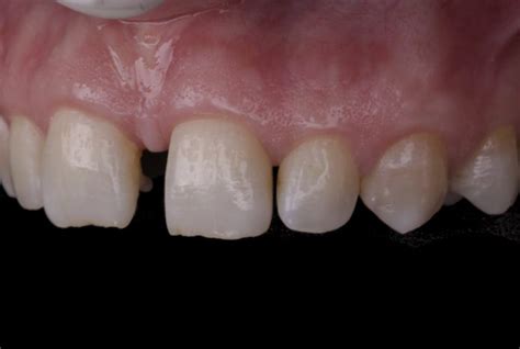 A Combined Approach For Diastema Closure Styleitaliano Org