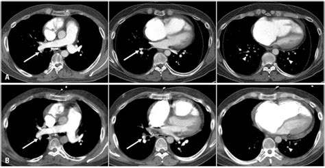 A Baseline Computed Tomographic Pulmonary Angiography Ctpa Performed Download Scientific