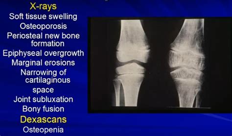 Juvenile Idiopathic Arthritis Orthopaedicprinciples