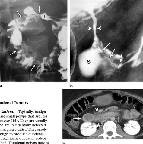 Duodenal Crohn Disease In Three Patients A Image From A Download Scientific Diagram