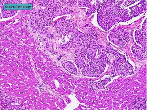 Qiao S Pathology Pancreatic Neuroendocrine Tumor Metastas Flickr