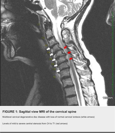 Figure 1 From Five Level Anterior Cervical Discectomy And Fusion Semantic Scholar