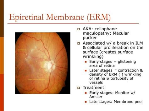 Epiretinal Membrane Stages