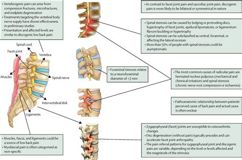 Low Back Pain The Lancet