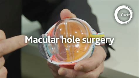 Macular Hole Surgery - Tanner Eyes