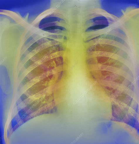 Chronic Bronchitis X Ray Stock Image M120 0110 Science Photo Library