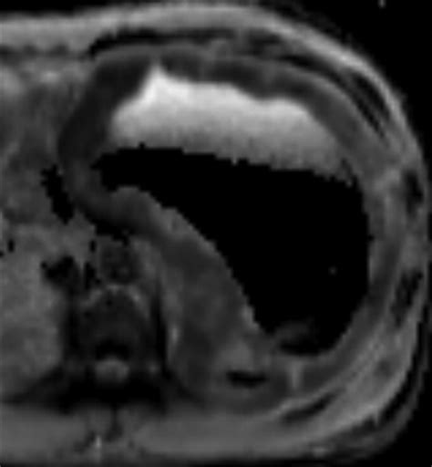 MRI Features Of Gastrointestinal Stromal Tumors AJR