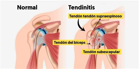 Tendinitis de supraespinoso en qué consiste Dr Miguel Romero