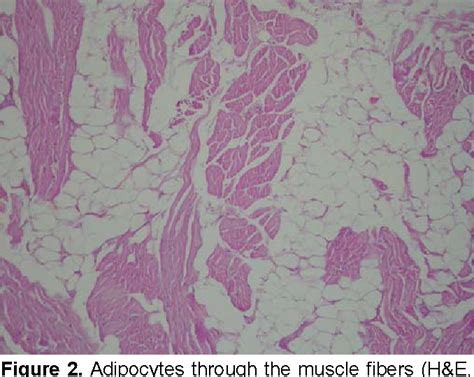 Pdf Intramuscular Lipoma Of The Tongue A Case Report And Review Of