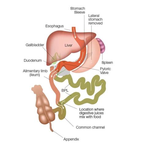 Duodenal Switch Plano Tx Biliopancreatic Diversion Texas Center