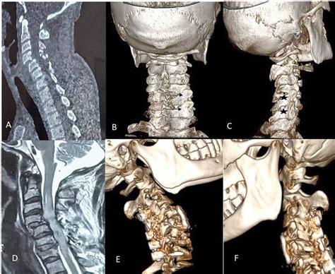 Contiguous Level Unilateral Cervical Spine Facet Dislocation—a Report