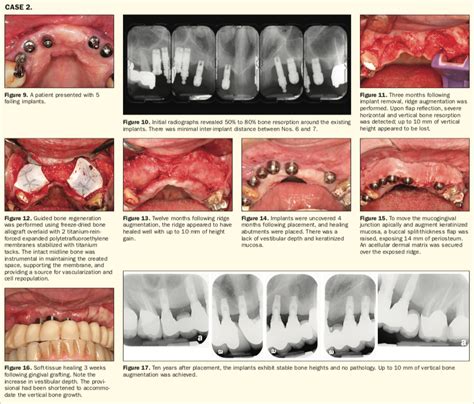 Maxillary Implants A Fix In Previously Failed Sites Dental Jay