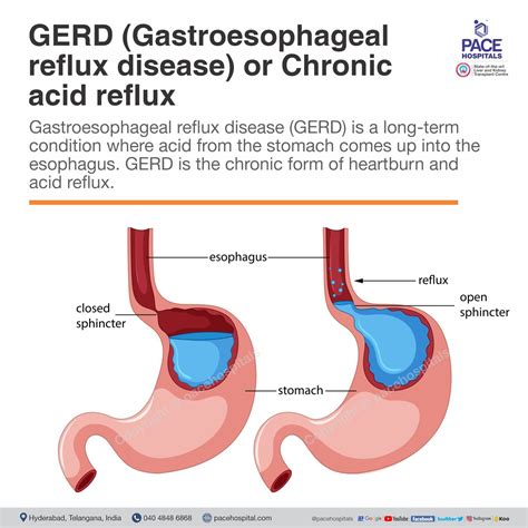 Gerd Or Chronic Acid Reflux Symptoms Causes And Treatment