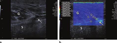 Acute tennis leg injury in a 51-year-old man. (a) Long-axis gray-scale ...