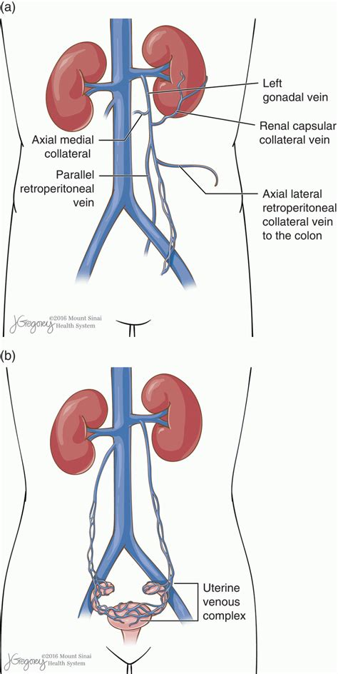 Gonadal Vein Anatomy