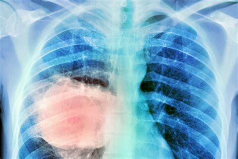 Lung Cancer Survival Improves In France Altus Intel