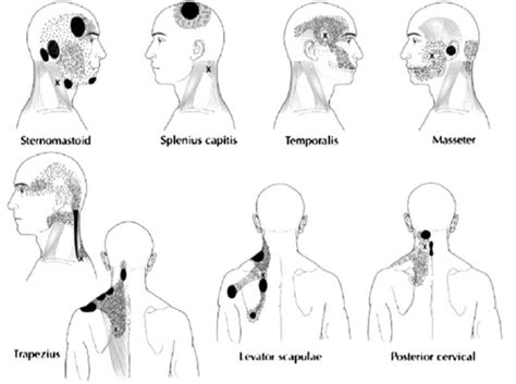 UNDERSTANDING CLOWARD SIGN | Rehab Code