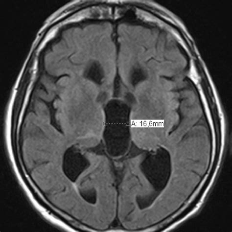 Axial View On The Flair Sequence Fluid Attenuated Inversion Recovery Download Scientific