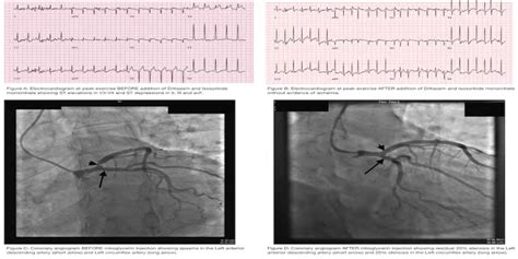 A Unique Presentation Of Exercise Induced Coronary Vasospasm Journal