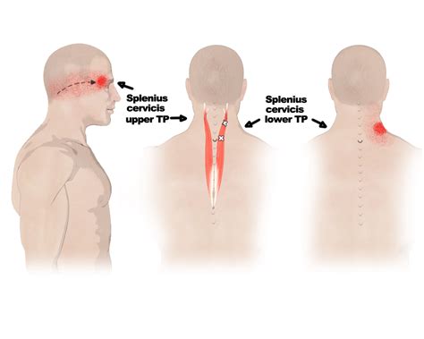 Splenius Capitis Trigger Points