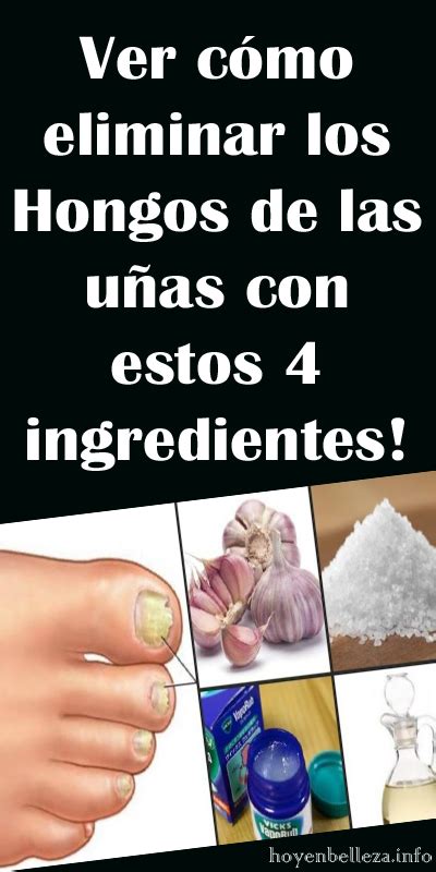 Ver Cómo Eliminar Los Hongos De Las Uñas Con Estos 4 Ingredientes Remedios Para La Salud