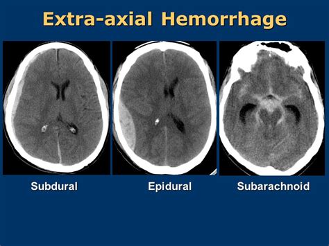 Subdural Hematoma Vs Epidural Hematoma