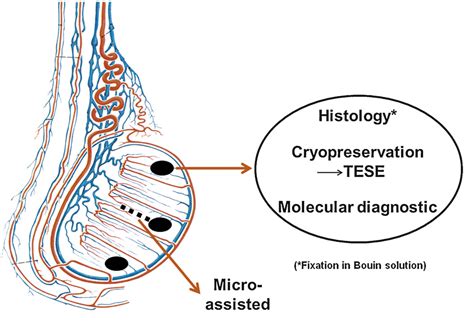 Table 1 From Combined Trifocal And Microsurgical Testicular Sperm