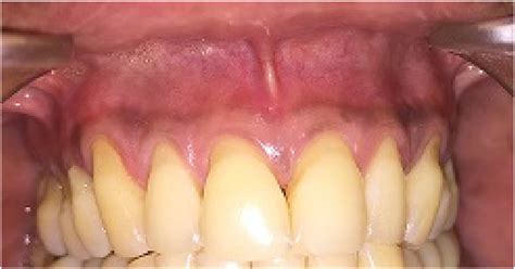 A Baseline Situation Showing Multiple Gingival Recessions In The