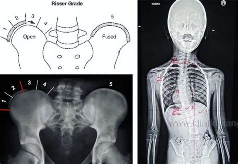 Skoliosis Pada Remaja Atasi Dengan Brace Gbw