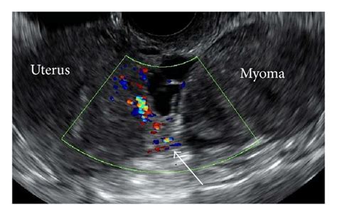 Transvaginal Color Doppler Ultrasonography Showing A Pedunculated Myoma