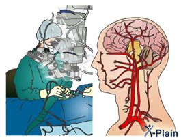 Trigeminal Neuralgia - Microvascular Decompression