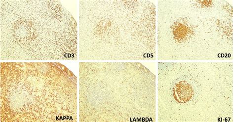 Immunohistochemistry Showing Cd20 Positive B Cells In The Lymphoid