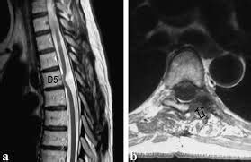 PARAPLEJIA ESPASTICA HEREDITARIA Binipatia E Higienismo