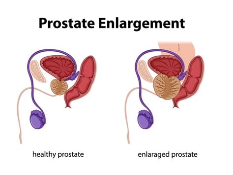 Prostate Enlargement And Aging What Men Need To Know