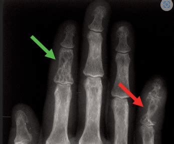 Rheum Other Rheum Diseases Flashcards Quizlet