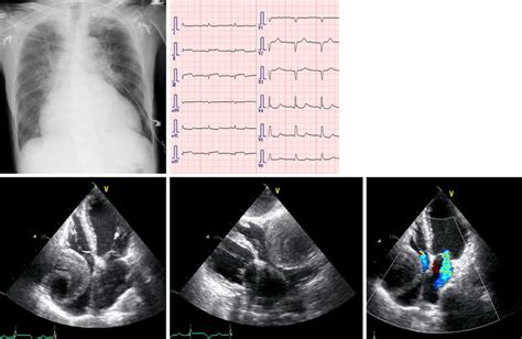 Figure Chest X Ray Film A Electrocardiogram B And Echocardiogram