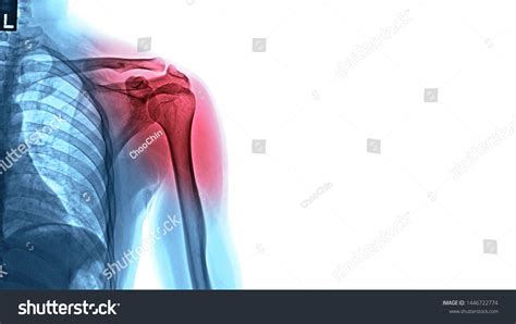 Xray Image Shoulder Pain Shoulder Ligament ภาพประกอบสต็อก 1446722774