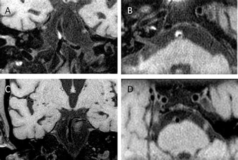 Figure 1 From Vertebrobasilar Artery Geometry And Bisilar Artery