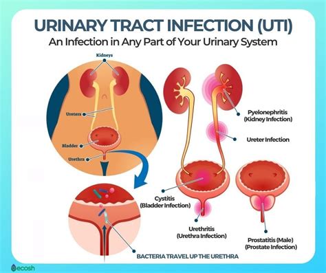 Urinary Tract Infections Utis Symptoms Causes And Natural Remedies For