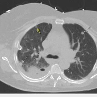 Chest Ct Scan Large Right Loculated Pleural Effusion With