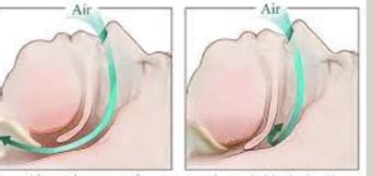 Obstructive Sleep Apnea And Hypoventilation Syndrome Flashcards Quizlet