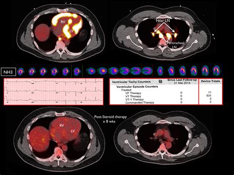 Incidence Of Abnormal Positron Emission Tomography In Patients With