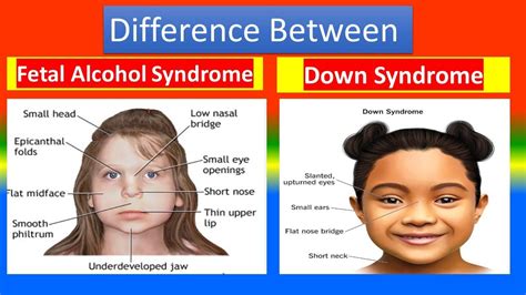 Distinction Between Fetal Alcohol Syndrome And Down Syndrome YouTube