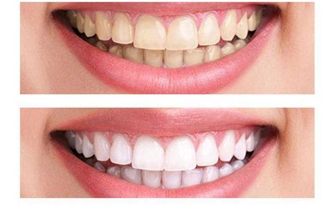 Teeth Whitening Turkey Up To 75 OFF Cosmetic Dentistry MedAway